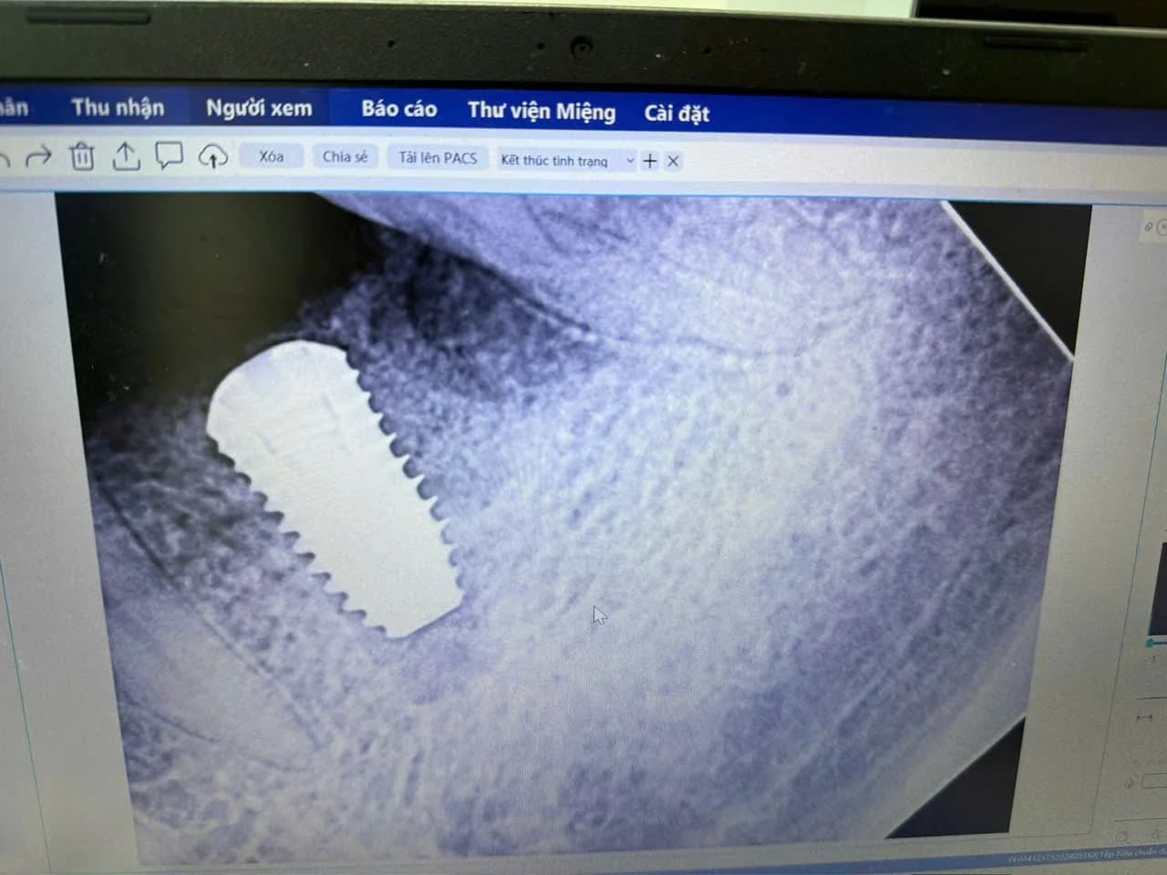 Phim X-quang kiểm tra vị trí trụ Implant ngay sau khi cấy tức thì