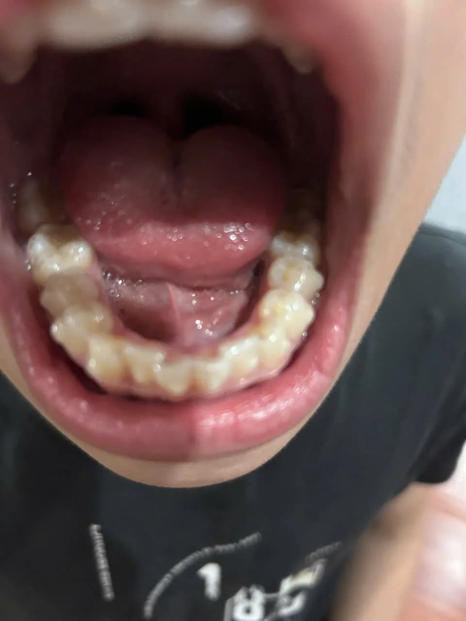 Cung răng sau chỉnh nha, các răng đã về đúng vị trí trên cung hàm