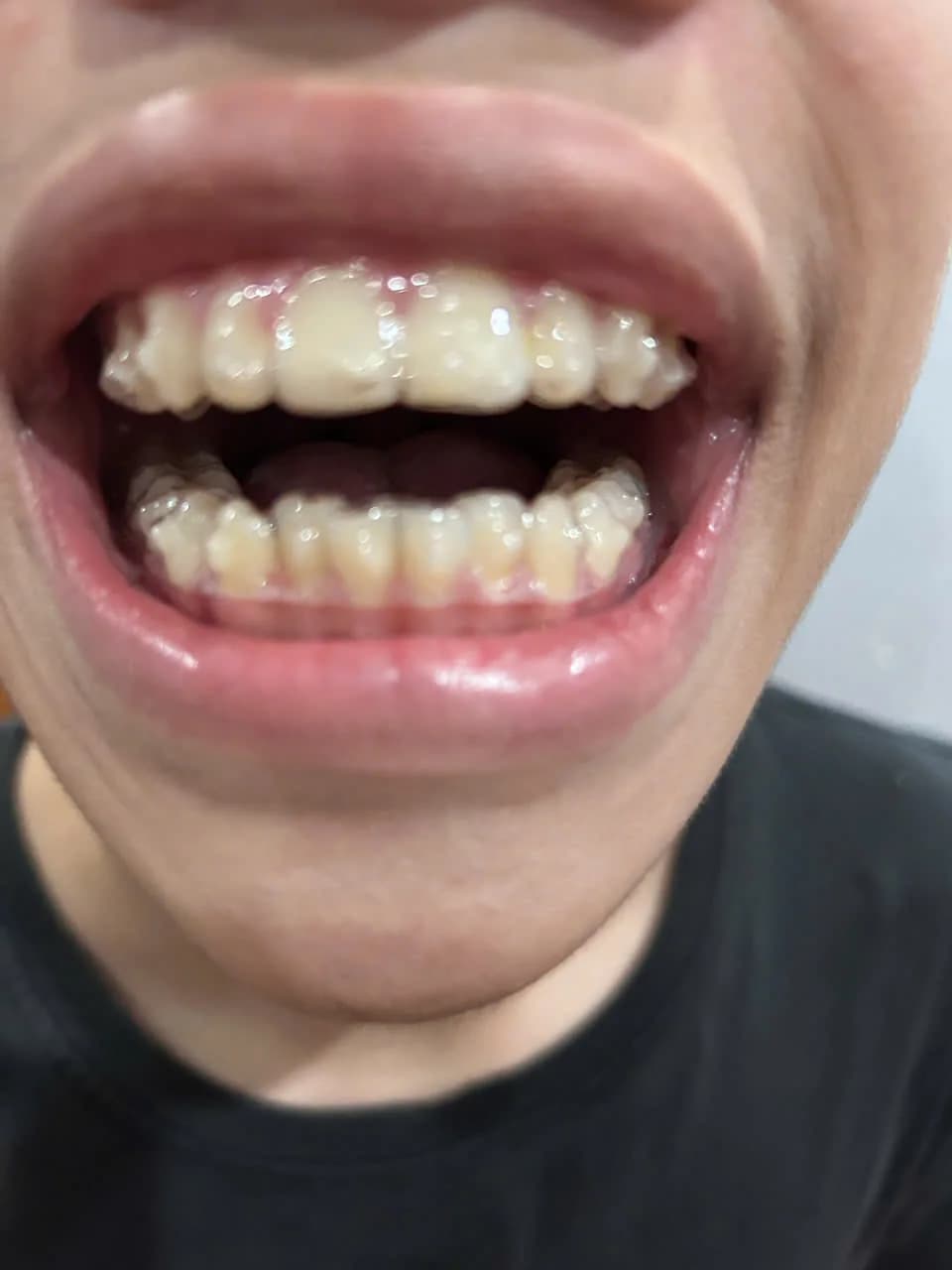 Nụ cười sau khi hoàn tất chỉnh nha tại Nha khoa Hiếu Minh