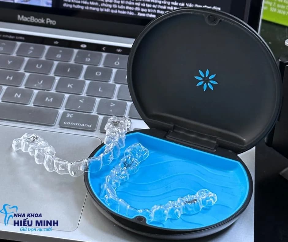 Mô phỏng kết quả niềng răng Invisalign trên phần mềm