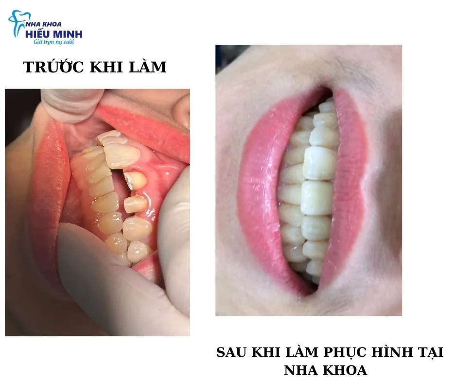 Hình ảnh trước và sau khi làm phục hình răng sứ tại Nha khoa Hiếu Minh