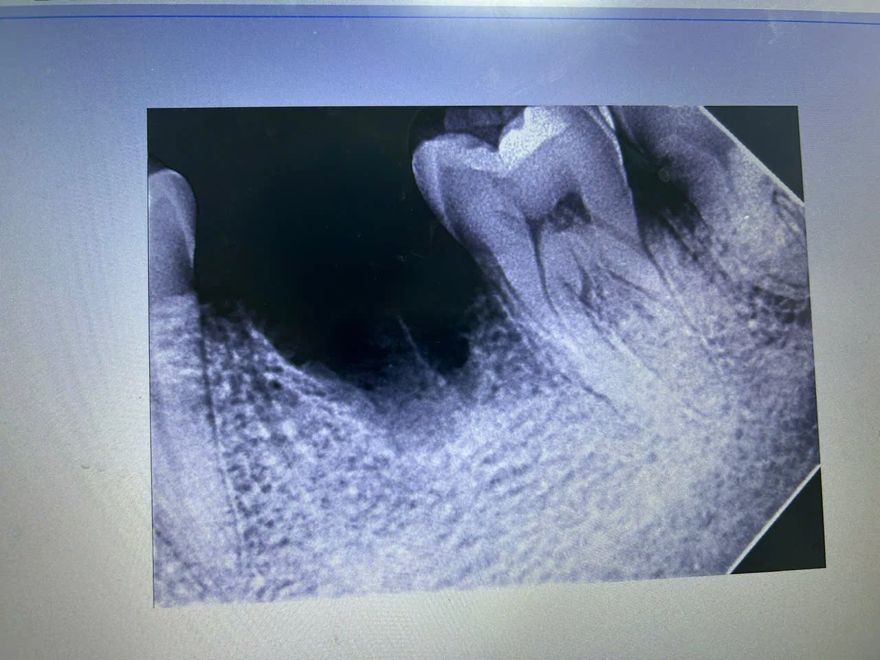 Phim chụp đánh giá xương hàm quanh vị trí cấy ghép Implant