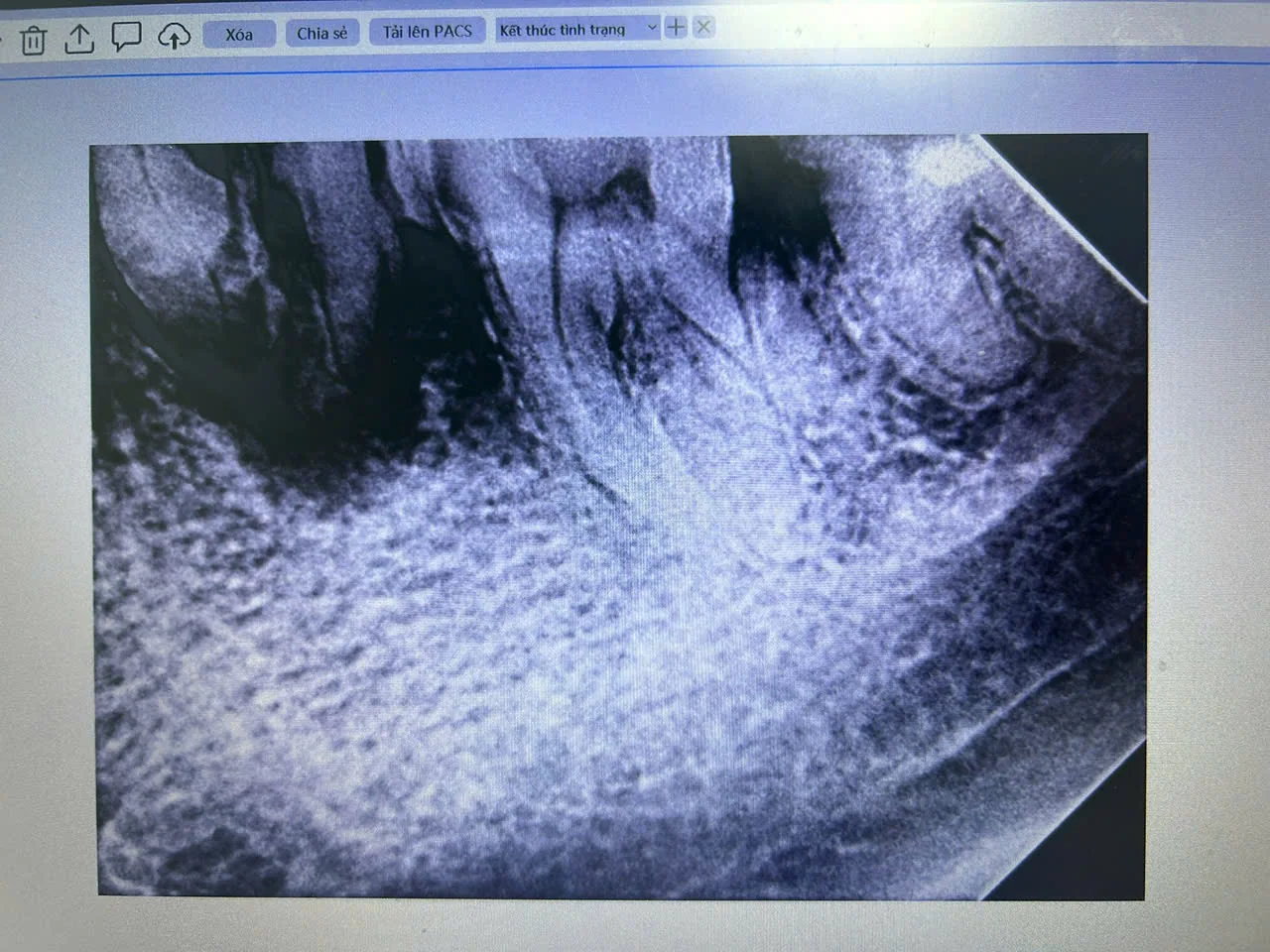 Chân răng hỏng cần nhổ bỏ trước khi cấy ghép Implant tức thì