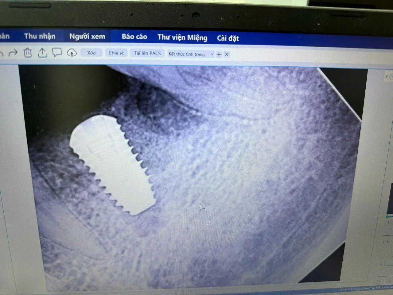 Phim X-quang kiểm tra vị trí trụ Implant ngay sau khi cấy tức thì