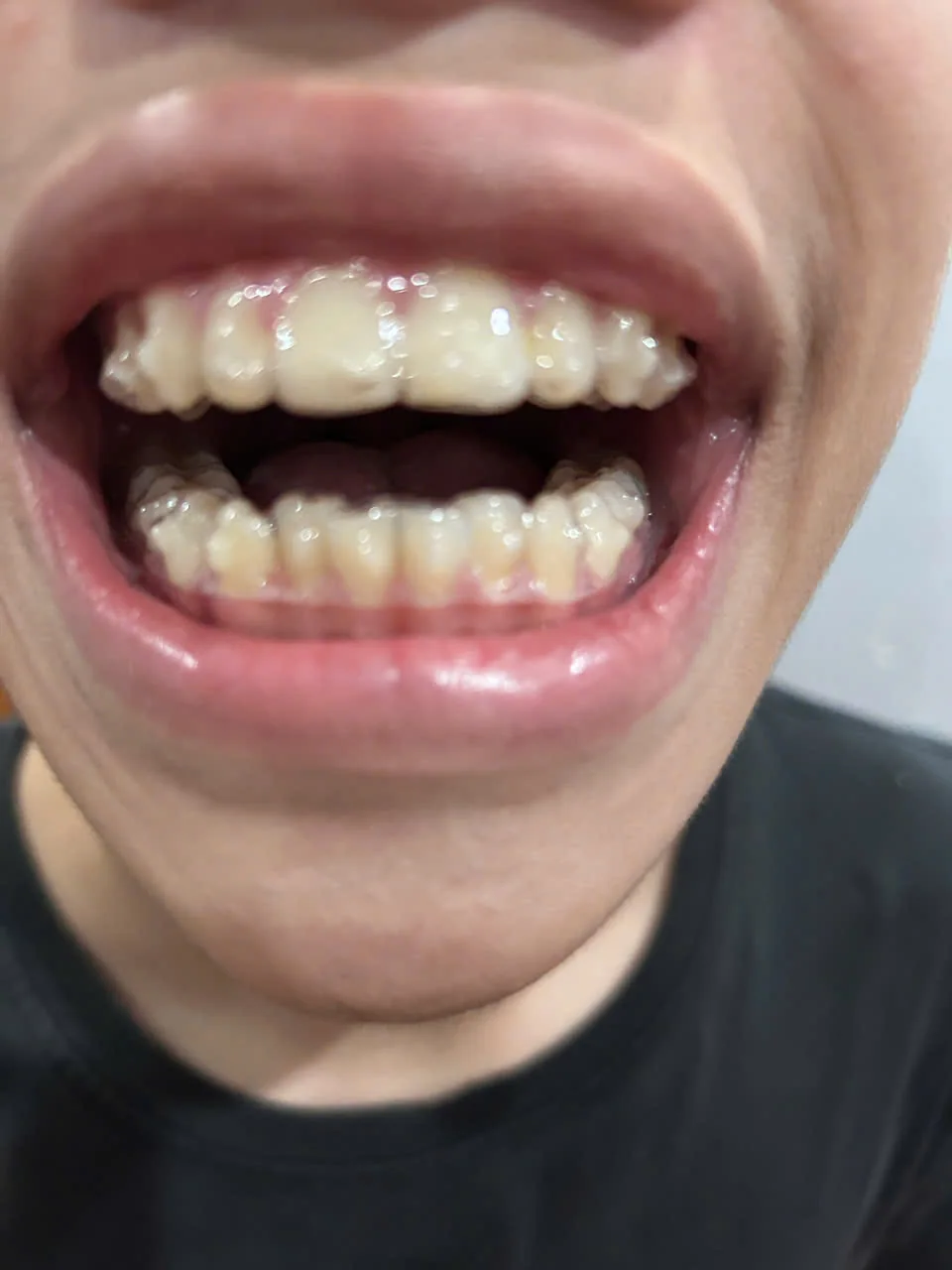 Nụ cười sau khi hoàn tất chỉnh nha tại Nha khoa Hiếu Minh