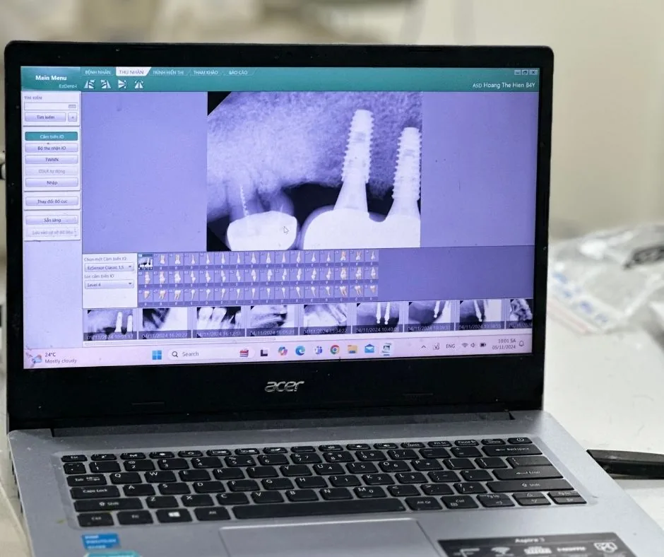 Phim X-quang đánh giá xương hàm trước khi cấy ghép Implant